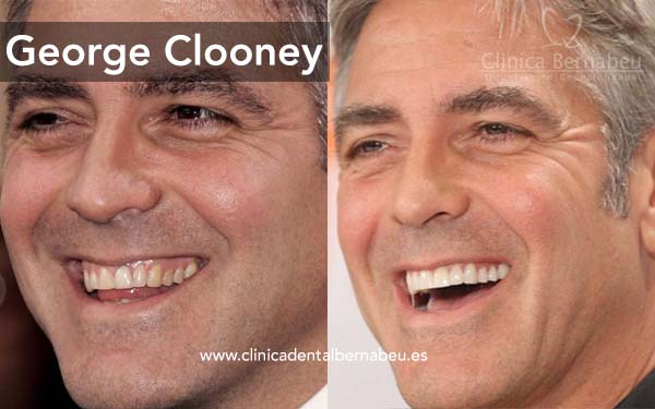 George Clooney carillas