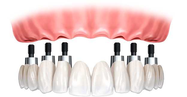 dentadura fija sobre implante
