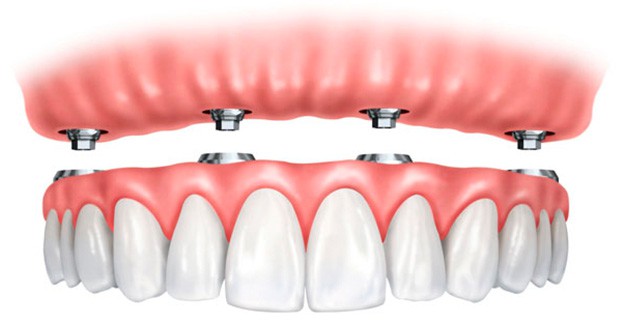 Dentadura Híbrida | Sobre implantes | Clínica Dental Bernabeu ®