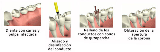 endodoncia unirradicular tratamiento y procedimiento