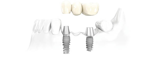 precio de los implantes dentales
