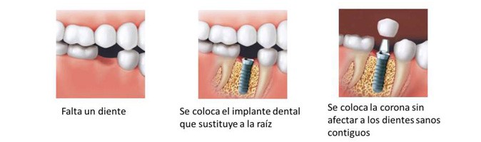 Colocación de Implantes dentales