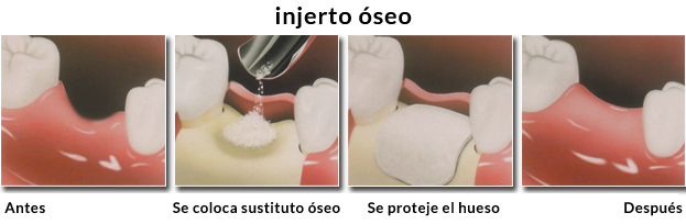 implante dental con poco hueso