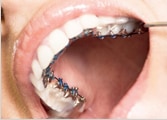 ortodoncia lingual brackets