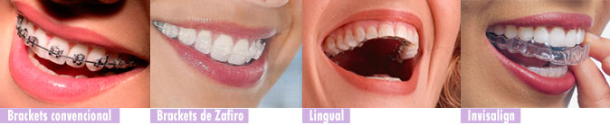tipos de ortodoncia en madrid