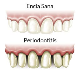 Síntomas de la Periodontitis