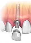 Prótesis dental implante