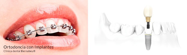 Ortodoncia con implantes dentales