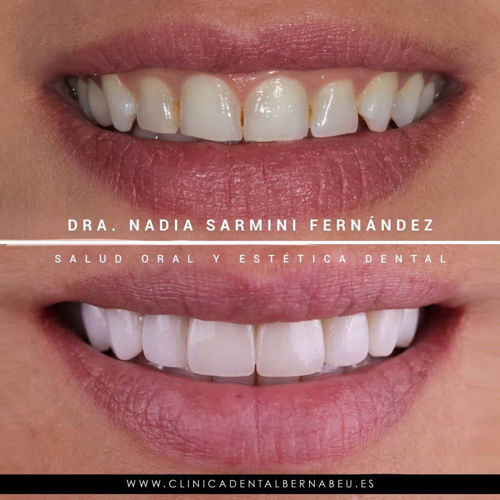 Las carillas de porcelana cerámica e.max pueden ayudar a solucionar:
