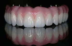 ¿Qué es la dentadura híbrida?