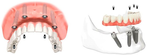 ¿Cómo se coloca la dentadura híbrida?