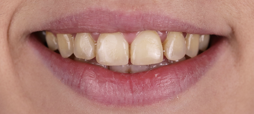 Boca antes de tratamiento de carillas dentales