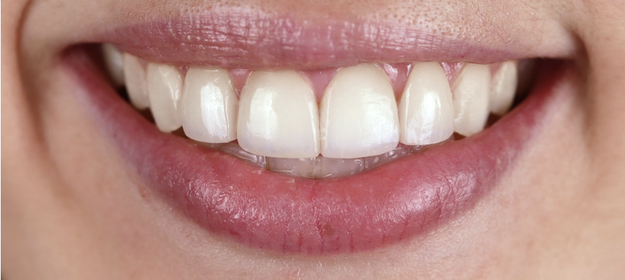 Resultado de tratamiento de carillas dentales