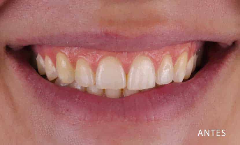 Carillas dentales sin tallado antes