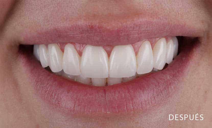 Carillas dentales sin tallado después