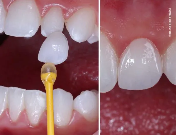 Carillas sin tallado