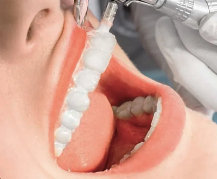 Mantenimiento de carillas dentales