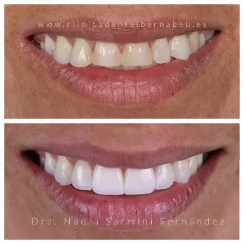 Cambio de carillas dentales