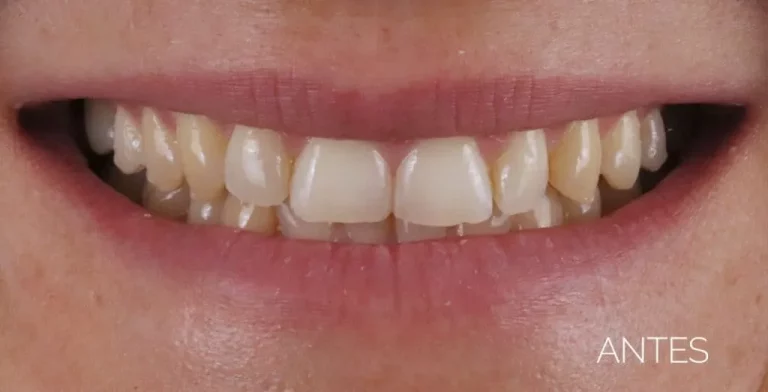 Sin Carillas de composite