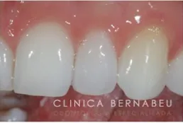 Clínica CARILLAS FALDESPÁTICAS EN MADRID