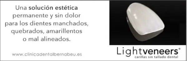 Carilla light veneers Madrid