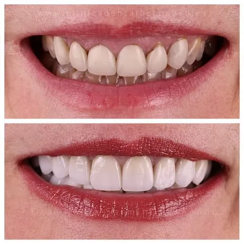 Cambio de carillas de porcelana