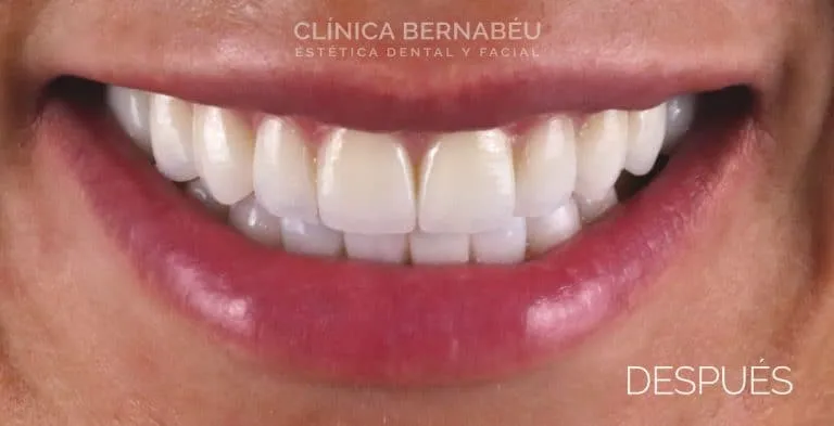 Después - Con carillas de porcelana