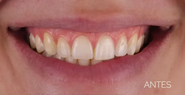 Carillas dentales sin tallado antes