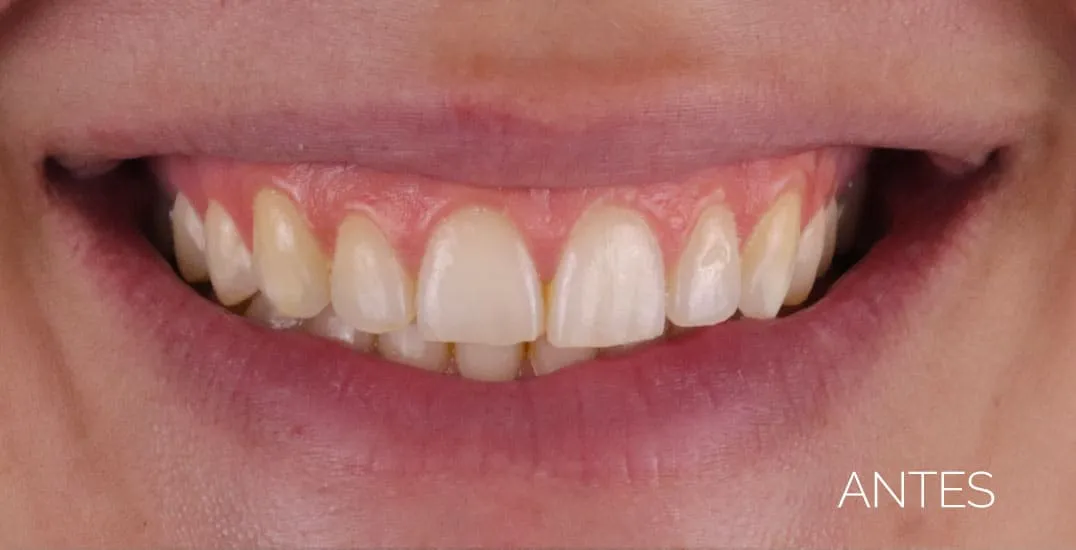 Carillas dentales sin tallado antes