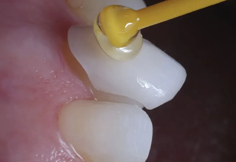 Foto de Carilla de porcelana