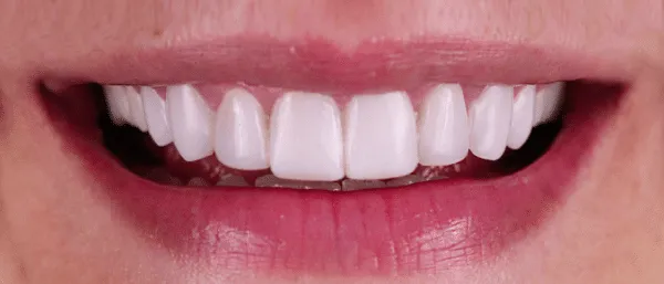 Sustitución de carillas de composite