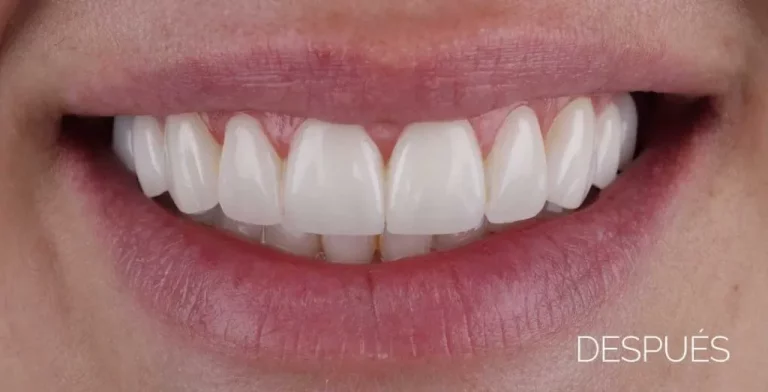 Carillas dentales sin tallado después