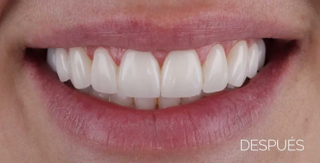 Carillas dentales sin tallado después