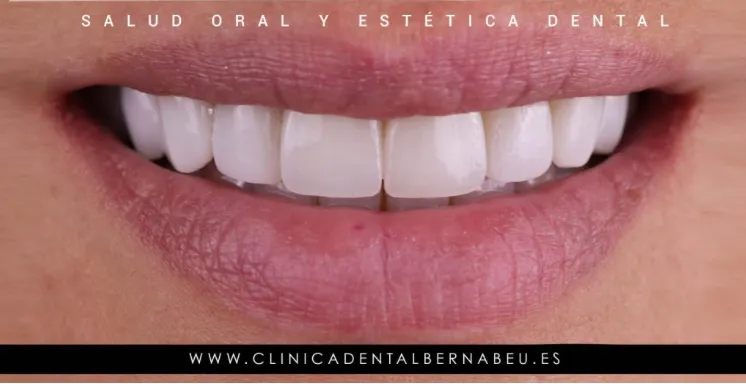 Después de carillas emax