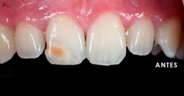 carilla de composite en un solo diente Antes