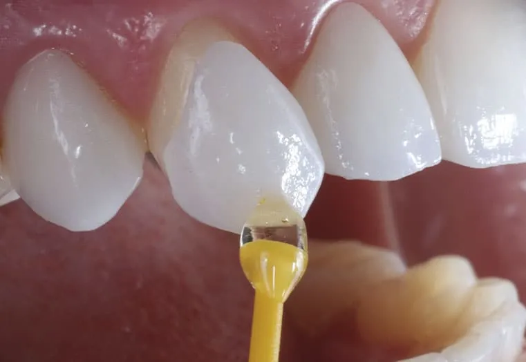 tratamiento de Colocación de carillas dentales estéticas