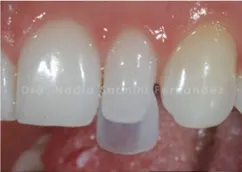 CARILLAS FALDESPÁTICAS MADRID