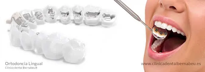 Ortodoncia lingual Madrid coste