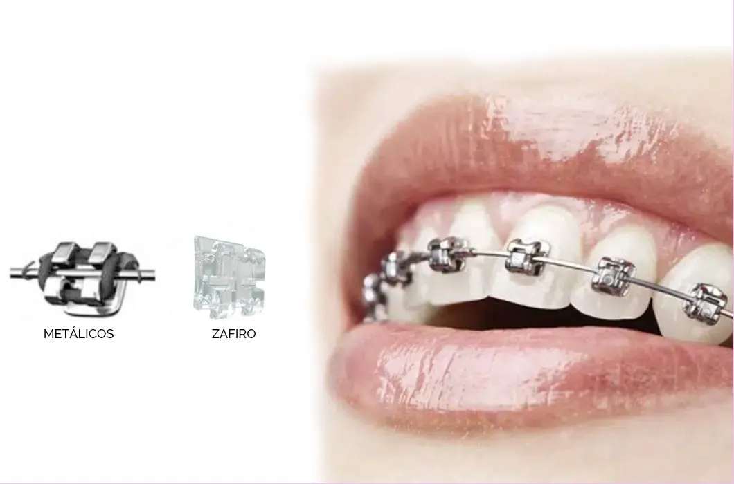 Ortodoncia personalizada Madrid de brackets