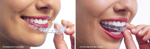 ortodoncia invisible Madrid tratamiento