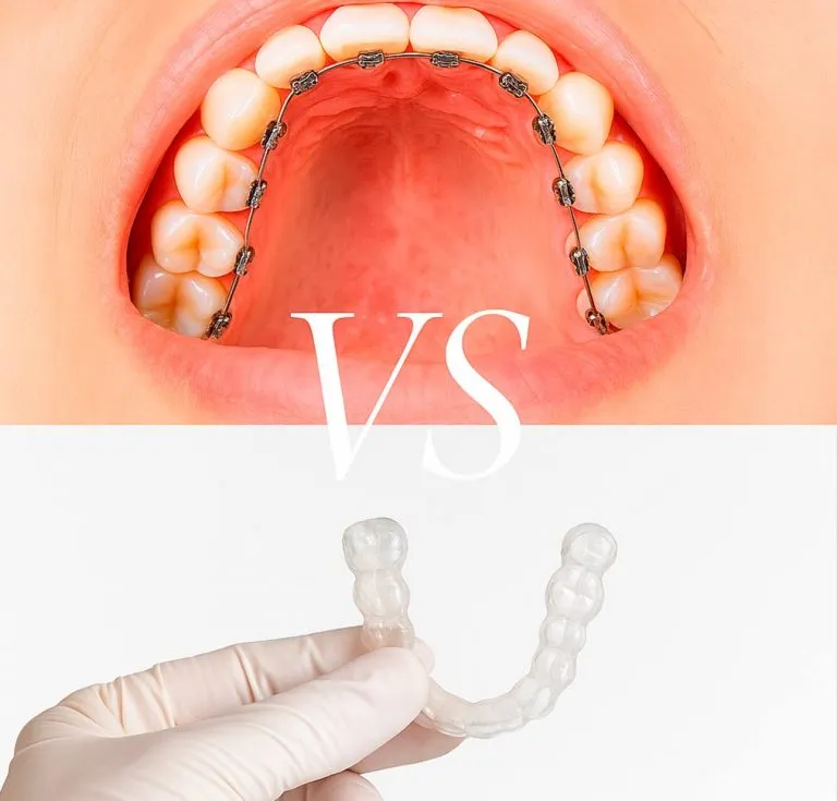 tipos de ortodoncia invisible comparativa
