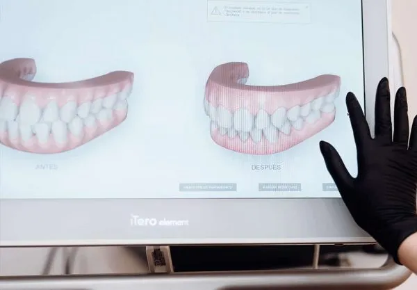 Invisalign en Madrid