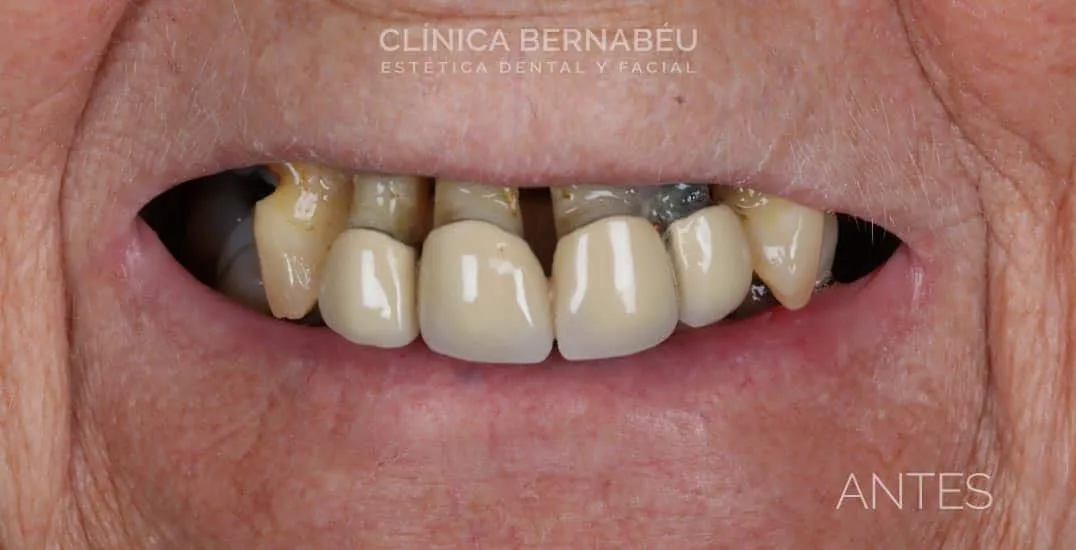 Antes del precio de implantes dentales