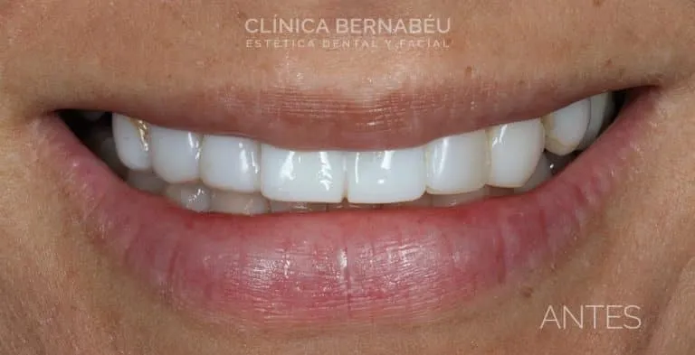 antes de los implantes dentales
