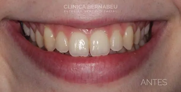 ejemplo de blanqueamiento dental