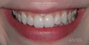 Efectos después del tratamiento de blanquemaiento