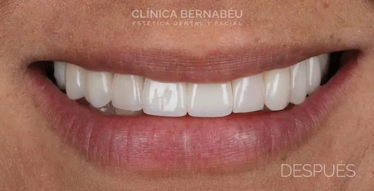 Después de los implantes dentales