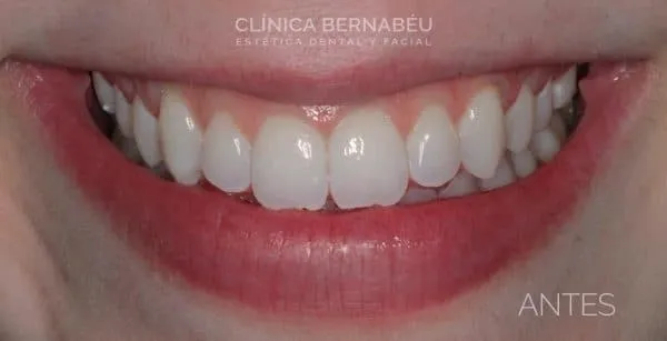 Efectos después del tratamiento de blanquemaiento