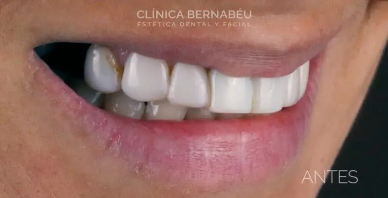 Antes del implante dental