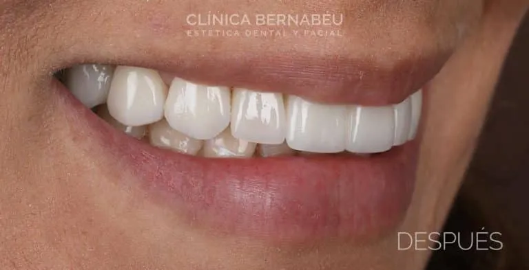 Después del Implante dental